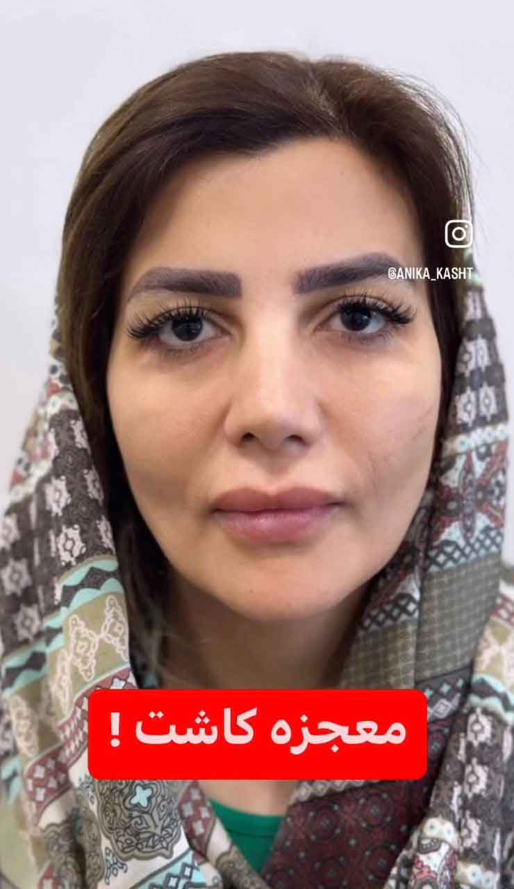 معجزه کاشت ابرو 